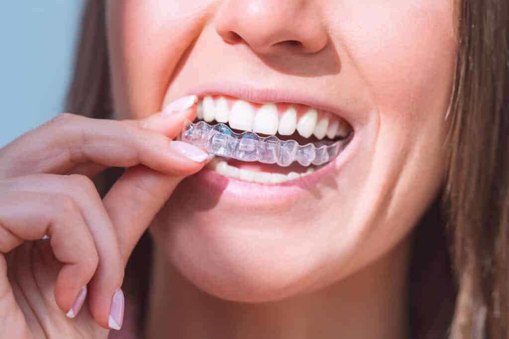 Close-up of woman putting on clear aligner for invisible orthodontic treatment