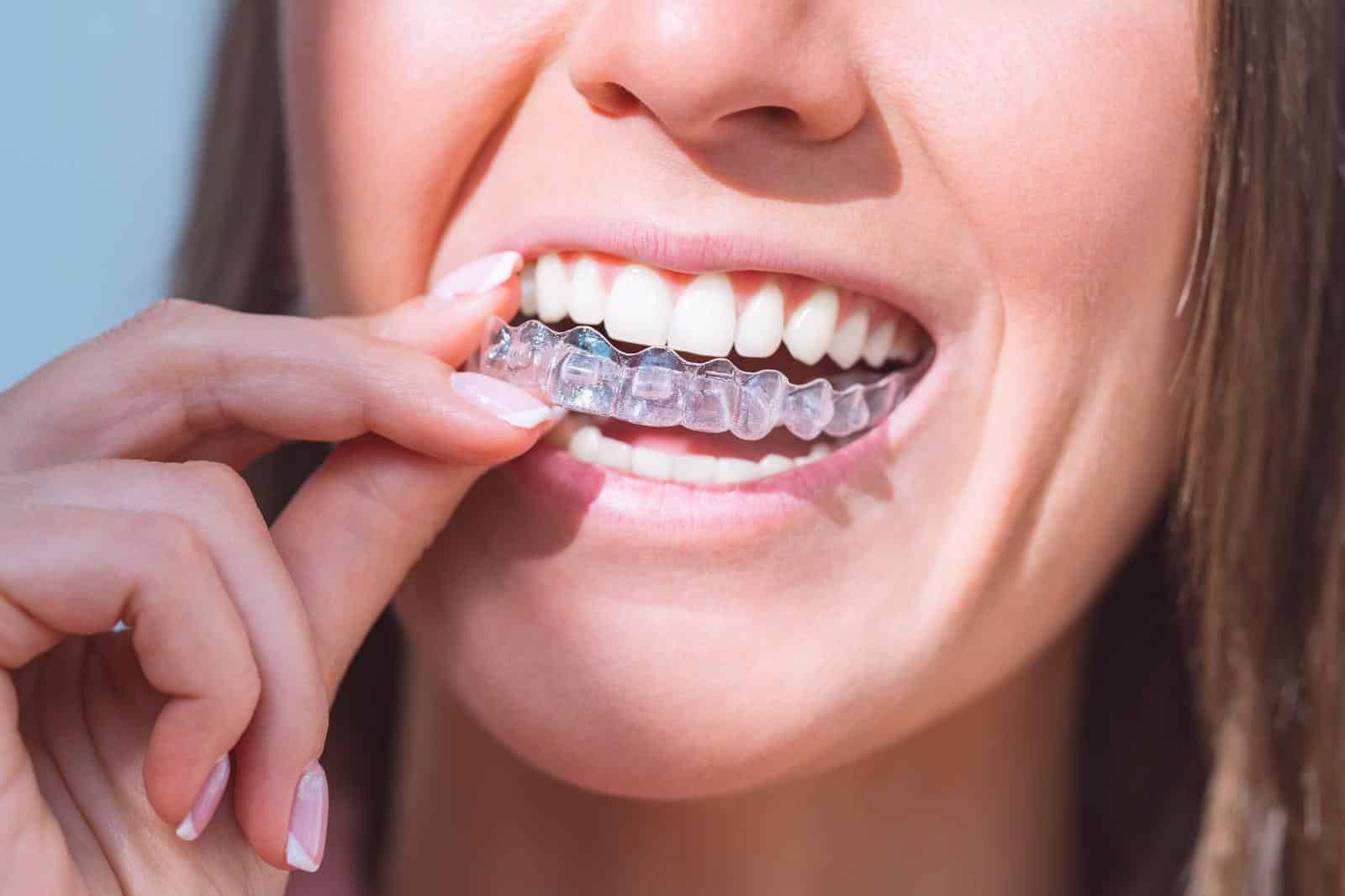 Read more about the article Clear Aligners and Speech: Will They Affect the Way You Talk?