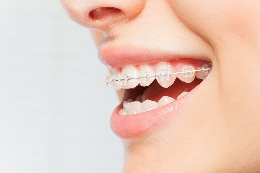 man holding Clear Braces Treatment in alpharetta and atlanta