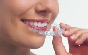 Close-up of a smiling woman placing an Invisalign clear aligner on her teeth, demonstrating proper use for best orthodontic results.