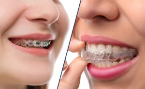 Side-by-side comparison of traditional metal braces and Invisalign clear aligners, showing how orthodontic treatments have evolved for comfort and appearance.