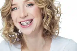 Adult smiling while wearing metal braces, showing traditional orthodontic treatment for teeth alignment