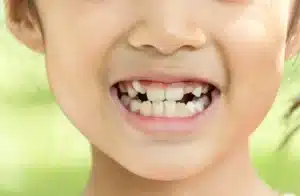 Close-up of a child smiling with crowded baby teeth