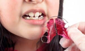 Child holding a removable orthodontic retainer near their mouth