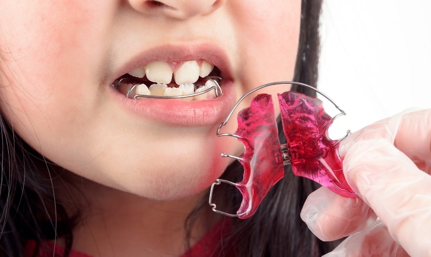 Read more about the article Why Retainers Are Just as Important as Braces: What Happens If Kids Stop Wearing Them?
