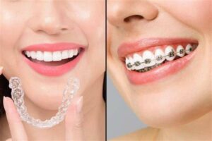 Comparison of clear aligners and traditional metal braces for teeth straightening treatment