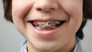 Child wearing metal braces for deep bite correction and teeth alignment treatment
