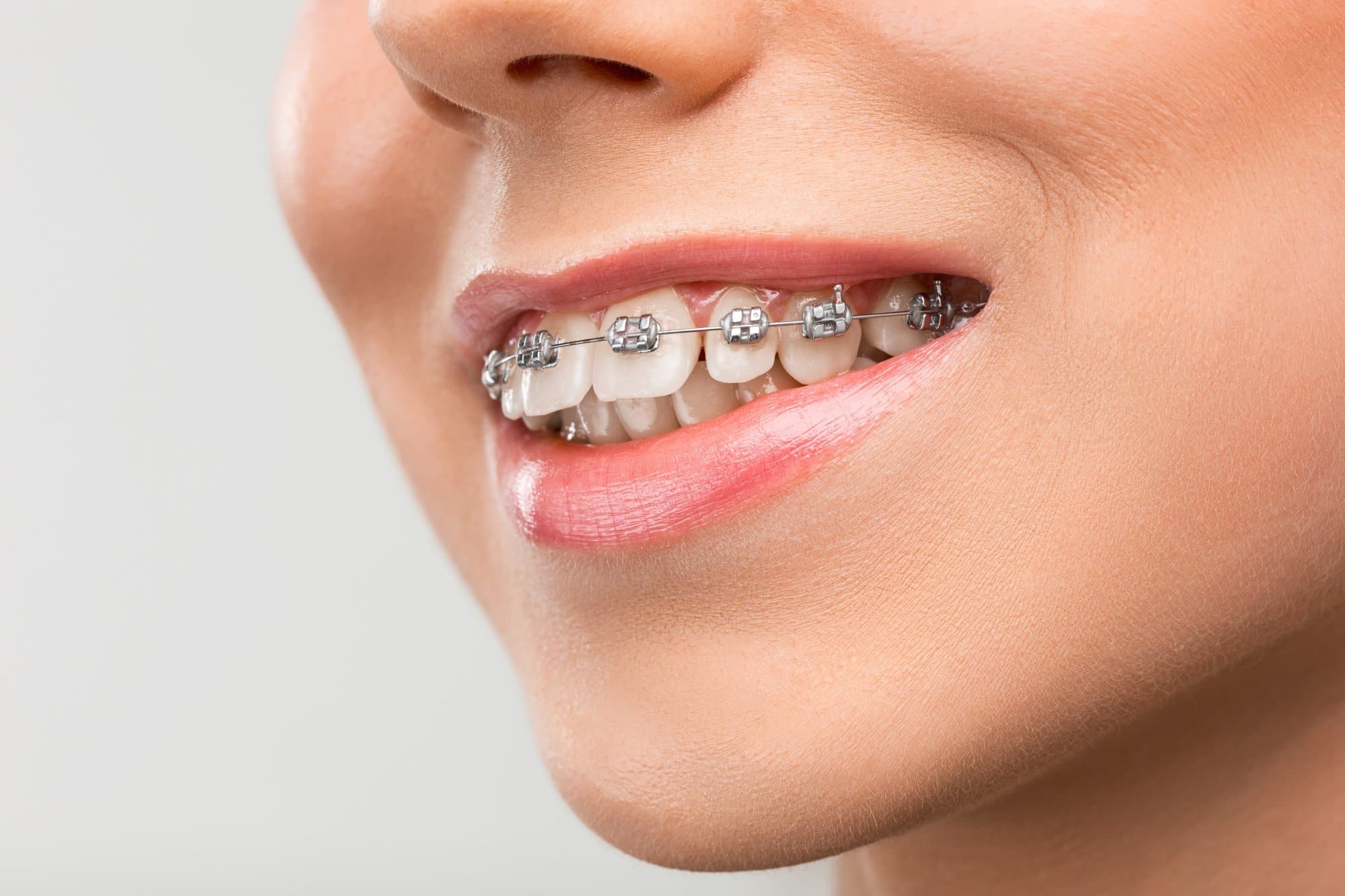 Read more about the article How Long Do Braces Take? A Realistic Timeline Based on Your Case