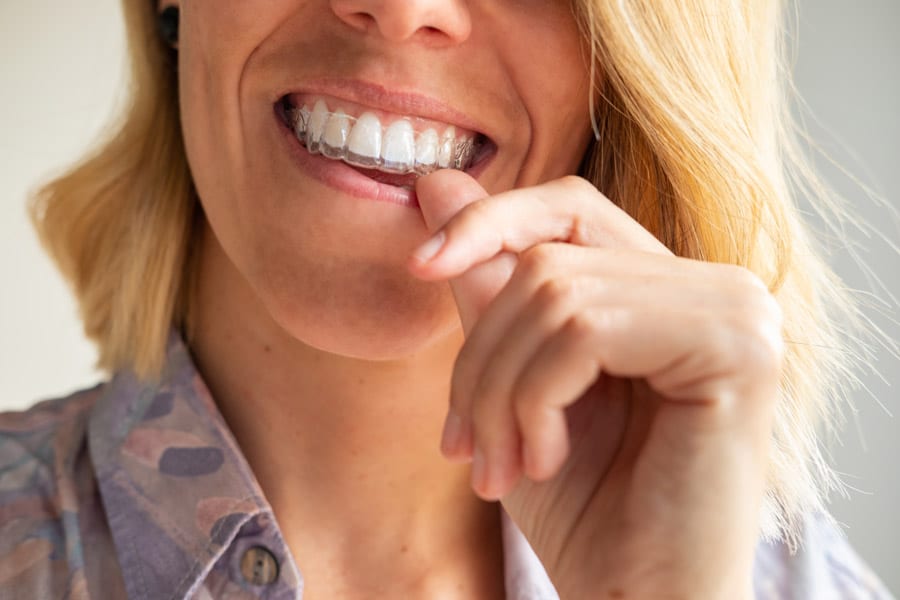 Read more about the article Invisalign Refinements Explained: Why Some Patients Need Extra Aligners