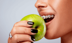 Close-up of a person with metal braces biting into a green apple, illustrating how hard foods can potentially damage orthodontic brackets and wires.