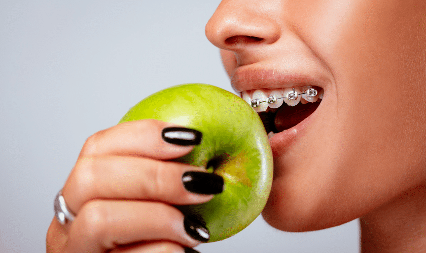 Read more about the article What Foods Cause the Most Damage to Metal Braces?