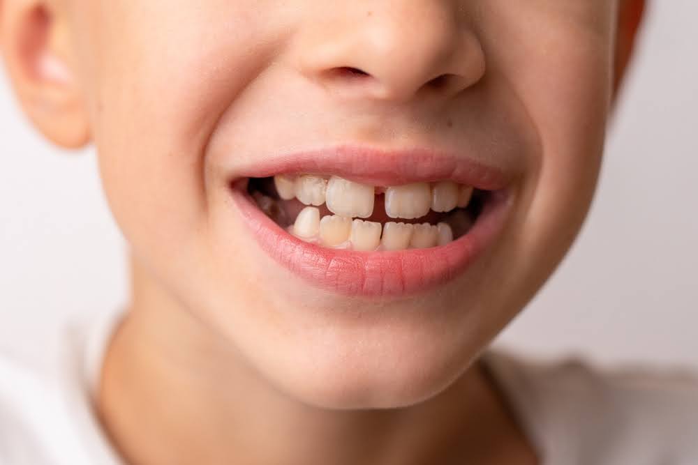 Close-up of a child showing bite alignment problems that may require early orthodontic evaluation and treatment.