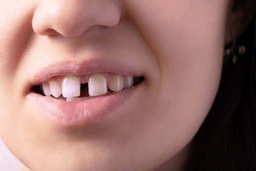 Close-up of a patient with a gap between the front teeth, a common orthodontic concern that can often be treated with clear aligners.