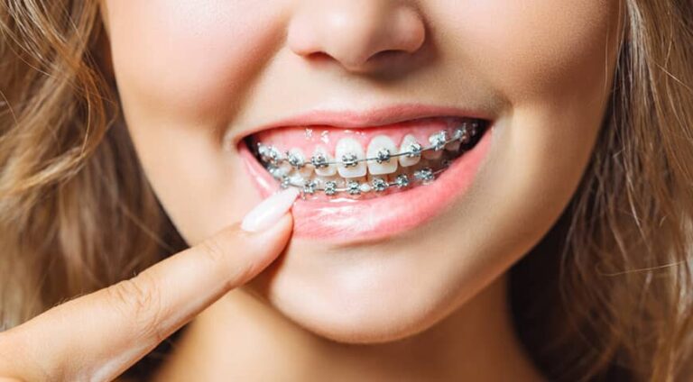 Close-up of a smiling patient wearing metal braces during orthodontic treatment to improve tooth alignment without tooth extractions when appropriate.